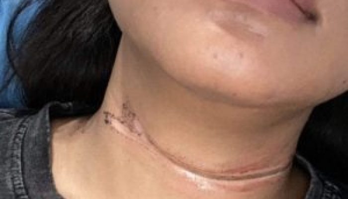 Warga Delima Nyaris Tewas Akibat Kabel Wifi Sembraut di Pekanbaru
